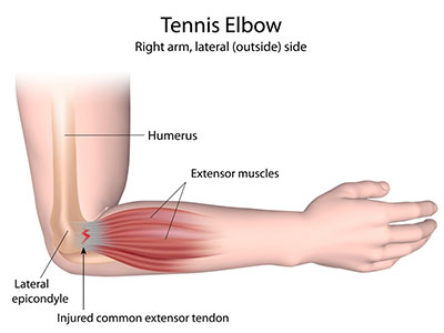 Lateral Epicondylitis
